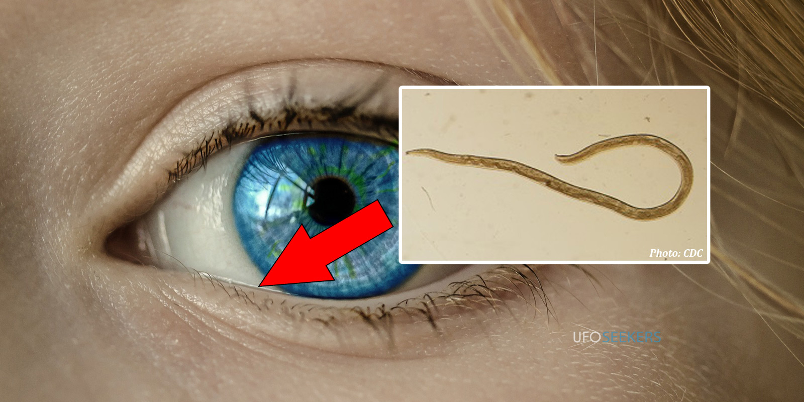 Parasite In Human Eye